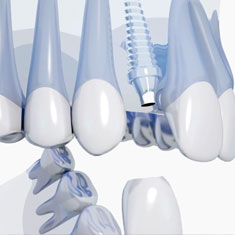 implantologie dentaire pont-à-mousson